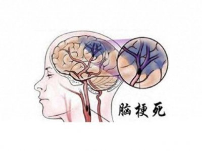 ​手脚血栓阻塞严重吗 血栓阻塞手脚有什么症状